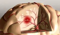 stroke